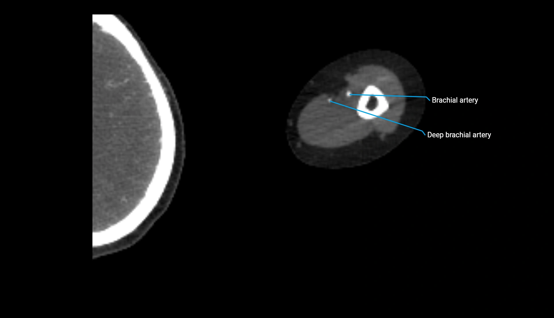 CTA upper limb axial cross sectional anatomy labelled image 228 (2).webp
